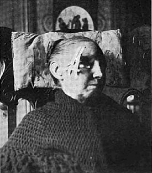 Application of radium tubes